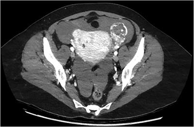 Ruptured ectopic pregnancy as complete hydatidiform mole: Case report and review of the literature